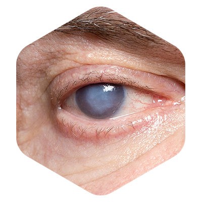 olho-cirurgia-de-catarata