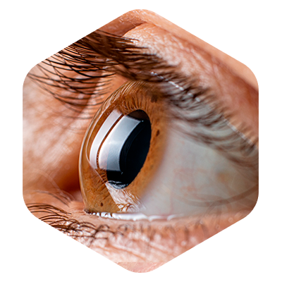 olho doença ocular ceratocone