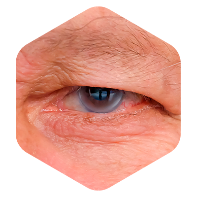 olho-tratamentos-glaucoma