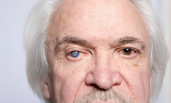 quais-sao-os-tipos-de-cirurgias-para-catarata