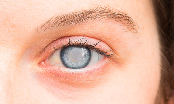 quais-tratamentos-sao-feitos-para-catarata